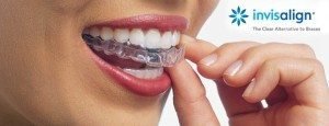 Invisalign1