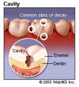 cavity