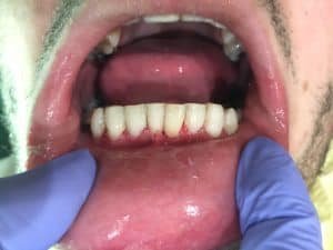 We were able to clean patient's teeth and remove plaque and calculus. In addition to Uveneer (bonded veneers) we were able to give the patient his smile without the aggressive approach. 