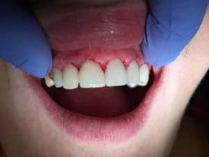 After 4 hours of dental restorative works and root canal therapies we ended up with this amazing result. MC now has her smile back and will be returning to finish the remainder of her treatment. 