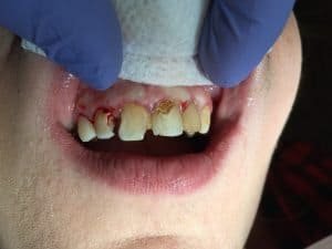 MC's teeth have been through a lot. Years of smoking and soda has cause major damage to her teeth and her self-confidence. 