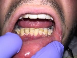 Pt presented with chief compliant "yellow teeth and ugly looking". Pt wanted to extract his lower teeth and get denture since it looks much prettier. 