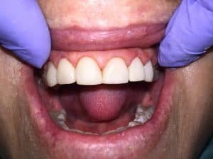 The result is nothing short of amazing. She spend many hours with us as we performed the necessary treatment to bring the life and beauty back to her teeth. We look forward to seeing the wedding picture. 