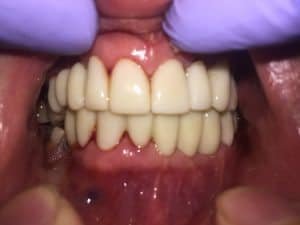 After several months of dental preparation and root canal therapies. We were able to restore years of damage. -Increase Vertical Dimension -Bridge #4-#8 -Bridge #9-#11 -Bridge #22-#27 -Single crown #12, #13, #20, #21 