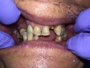 A great father, who put the needs of his children first. Spend years and years working two jobs to support his family. Meanwhile ignoring the desperate pleas of his oral health. 