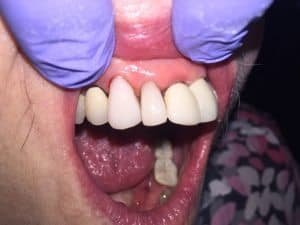 We used a basic etch and bonding technique that allow us to perform a composite veneer. Minimal reduction of tooth structures resulting in an amazing result. Procedure was done under 1 hr. Pt will return to get permanent crown place on #6 and #7. 