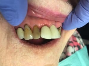 Pt has always been self-conscious of her smile due to the natural teeth color of #6 and #7. Pt wanted to something that will give her a preview of what her smile would look like. 