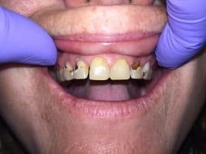 Pt have neglected her teeth for year due to a lack of finance and motivation. However, she is getting marry soon and wants to special her future husband with a smile she have NEVER showed anyone else before. 