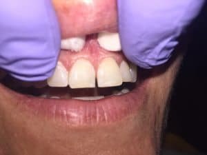 Pt chief complaint was the dark space in between her teeth. 