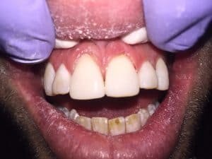 After UVeneer (Bonded technique) we were able to provide the patient with space closure and good coverage over the stained area of his teeth. Pt was extreme excited about showing off his new found smile. 
