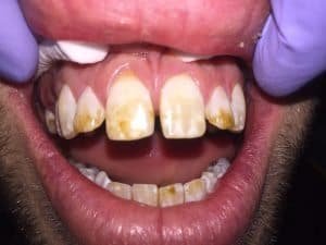 Pt was given Tetracycline as a children, which resulted in permanent staining of his teeth. Pt have tried multiple whitening session but nothing has help so far. In addition he was unhappy with the excessive amount of space in between his teeth. So we proposed some bonding technique to provide a good visual for the patient.